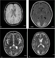 La mayoría de los casos, incluso los más graves, se recuperan totalmente. Guillain Barre Syndrome With Concurrent Posterior Reversible Encephalopathy Syndrome And Hyponatraemia Mere Coincidence Or Rare Coexistence Bmj Case Reports