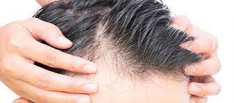 La caduta di capelli in condizioni normali è da ritenersi un naturale processo fisiologico di ricambio della capigliatura. Perdita Dei Capelli Nell Uomo Quali Sono Le Cause E Le Soluzioni Possibili