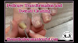 Pedicure Transformation Tutorial Deepest Ingrown Toenail Or Pincer Toenail Youtube Easy diy acrylic toenails😍~trendy toenails~ quarantine toenails😍.