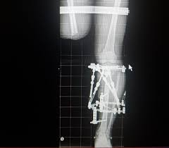 Episode 6: A New Hope - The Taylor Spatial Frame -