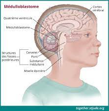 Cancer can cause different symptoms, such as abnormal bumps, night sweats, or unexplained weight gain or loss. Medulloblastome Chez Les Enfants Et Les Adolescents Ensemble