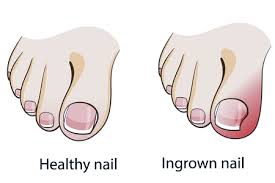 Most often a black spot that looks like you dropped something on your toe is an old hemorrhage from trauma. Skin And Toenail Conditions Desert Podiatric