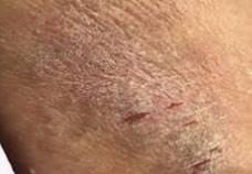 Image result for Neurodermatitis