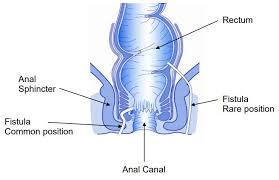 Obstetric fistula is a hole in the birth canal caused by obstructed labour. Anal Fistula Operations Milton Keynes University Hospital