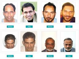 We will be talking about the best hair transplant clinics in turkey. Hair Transplant In Delhi Best Hair Transplant Clinic In Delhi