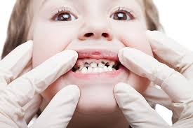 How to reverse tooth decay in babies. What Is Baby Bottle Tooth Decay Know What To Look For