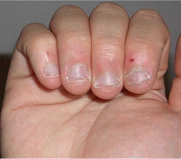 Mga resulta ng larawan para sa Nail and cuticle bitting"