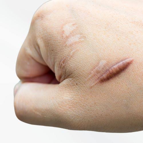 Keloid Scars: Info & Causes | Cosmedics Skin Clinics
