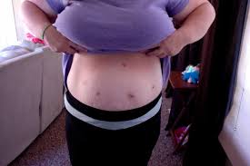 This surgery combines both restrictive and malabsorptive mechanisms. The Scars Dendee S Vertical Sleeve Gastrectomy Journey
