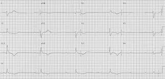Check spelling or type a new query. Av Block 3rd Degree Complete Heart Block Litfl Ecg Library