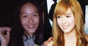 Kpop Female Idols Before And After Plastic Surgery Celebrity Plastic Surgery Plastic Surgery Cosmetic Surgery
