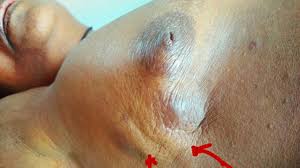 The symptoms of breast cancer in men include: 7 Pictures Of Breast Cancer