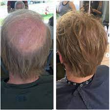Tips to help with your receding hairline. Defy The Receding Hairline And Get Hair Extensions Ergun Tercan