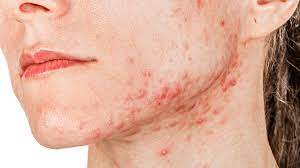 Check spelling or type a new query. 11 Ways To Get Rid Of Acne Naturally