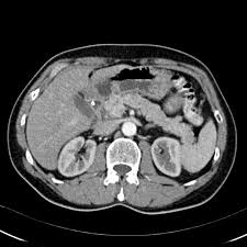 Diagnosis of pancreatic cancer involves tests such as health history, physical exam, blood tests, ct scan and ultrasound. Islet Cell Tumor Of The Pancreas Radiology Case Radiopaedia Org