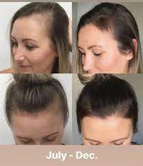Hairfortin For Baldness Remedy Formula In 2020 Hair Loss Remedies Women Hair Loss Women Thin Hair Styles For Women