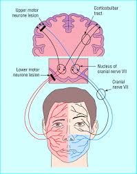 Look for a vi nerve palsy or other long tract or other cranial nerve signs which would isolate the lesion to the pons and suggest a central lesion. Recent Developments In Bell S Palsy The Bmj