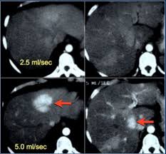 Image result for CT Intravenous Contrast