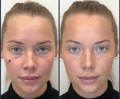 The photos say it all. Under Eye Fillers For Dark Circles Efficacy Photos Cost Side Effects