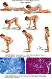 Gowers Sign Pediatric Nursing Muscular Dystrophies Nursing School Life