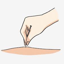 Acupuncturists insert needles into pressure points on clients' bodies to help relieve everyday stresses, and improve their wellbeing. The Acupuncture Society Professional Body Of Acupuncture Chinese Herbal Medicine