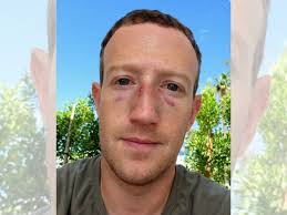 Is This Mark Zuckerberg With Injuries After Elon Musk 'Surprised' Him?