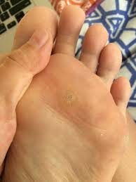 Maybe you would like to learn more about one of these? A 100 Day Journey Plantar Wart Treatment With 16 7 Salicylic Acid Duct Tape Success Story Album On Imgur