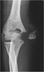 Failure to diagnose these injuries can lead. Medial Condyle Fracture Kilfoyle Type Iii Of The Distal Humerus With Transient Fishtail Deformity After Surgery