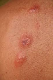 Image result for flea bite