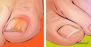 Apple cider vinegar bath is a known home remedy for yeast infection on skin and other skin fungus issues. 5 Simple And Effective Remedies To Treat Toenail Fungus