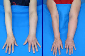 الوذمة اللمفاوية في الذراع بعد عملية الثدي د فراس الصفدي