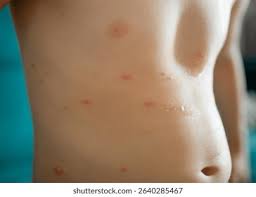 Image result for vyrážka u dětí