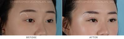 The mission of the pearl dermatology is to provide the most advanced technology and extensive expertise with an unfailing commitment to patient care. Asian Eyelid Double Eyelid Surgery Before And After Photo Gallery