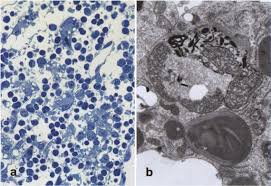 It can occur at any age. Foam Cells An Overview Sciencedirect Topics