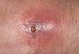 Mrsa also tends to result in longer, more expensive hospital stays than staph. Mrsa Infection Causes Symptoms And Treatment