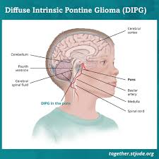 Left untreated, this condition can cause problems with brain development, leading to progressive mental retardation and seizures. Diffuse Intrinsic Pontine Glioma Dipg In Children Together