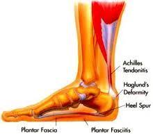Pin On Foot Pain