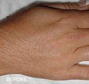 At fresh laser skin studio, we offer a comfortable, professional and private setting for hair removal on all skin types, all genders and on all areas of the body. Laser Hair Removal Washington Dermatology Consultants