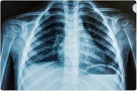 Care guide for ards (acute respiratory distress syndrome) (discharge care). Acute Respiratory Distress Syndrome Ards And Sepsis