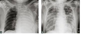 These bacteria can contaminate water. Racgp Melioidosis
