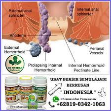 Satu ubat untuk buasir di farmasi disyorkan untuk merawat buasir. Ubat Buasir Buas Adalah Paling Berkesan Di Farmasi Ubat Sifilis De Nature Indonesia