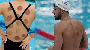 Get to know the ancient eastern treatment behind michael phelps's bruises. Athletes Use Of Cupping Draws Attention At The Tokyo Olympics Photos