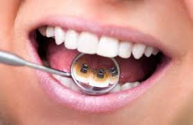 How to relieve pain from braces how to brush your teeth with braces. Coral Springs Orthodontist Braces Invisalign Coral Orthodontics