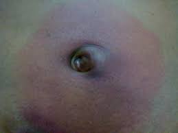 A bulge or sac containing fat or intestine. Figure 1 Strangulated Richter S Umbilical Hernia A Case Report Springerlink