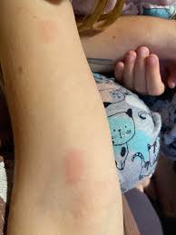 Image result for mite bites on humans