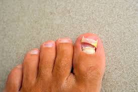 Image result for Toenail Removal