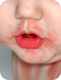 Image result for Angioedema