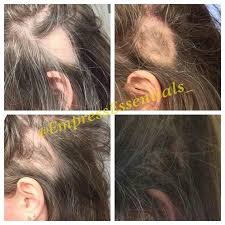 Castor oil is far from being a health and beauty product women know the benefits of castor oil for thick, luxurious hair, but castor oil is great in helping male pattern baldness. Hair Loss Treatment Hair Growth Cream 1 Month Supply Balding Alopecia Thin Edges Bald Spots For Men Or Women Black Castor Oil Hair Loss Remedies Women Hair Treatment Hair Growth Treatment