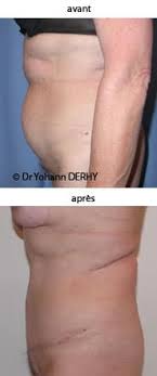 Avoir le ventre de vos rêves sans risques et sans difficultés, et surtout sans chirurgie, c'est possible ! Tarifs Et Prix Abdominoplastie Paris
