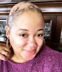 Life Update I Have Androgenetic Alopecia Whitney Nic James Androgenetic Alopecia Relaxed Hair Growth Alopecia Hairstyles